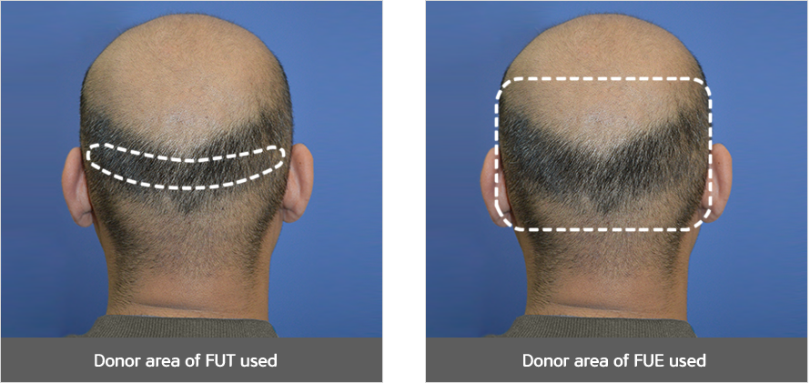 hair transplant in korea the black hair transplant